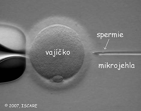 Mikroinjekce spermie do vajíčka